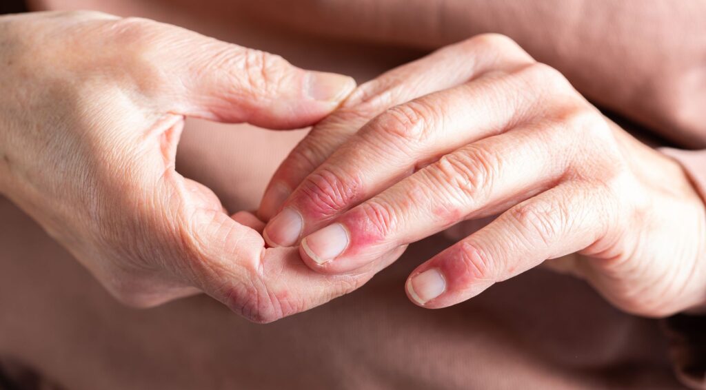 eczema coiffure, comment l'éviter et le soigner?